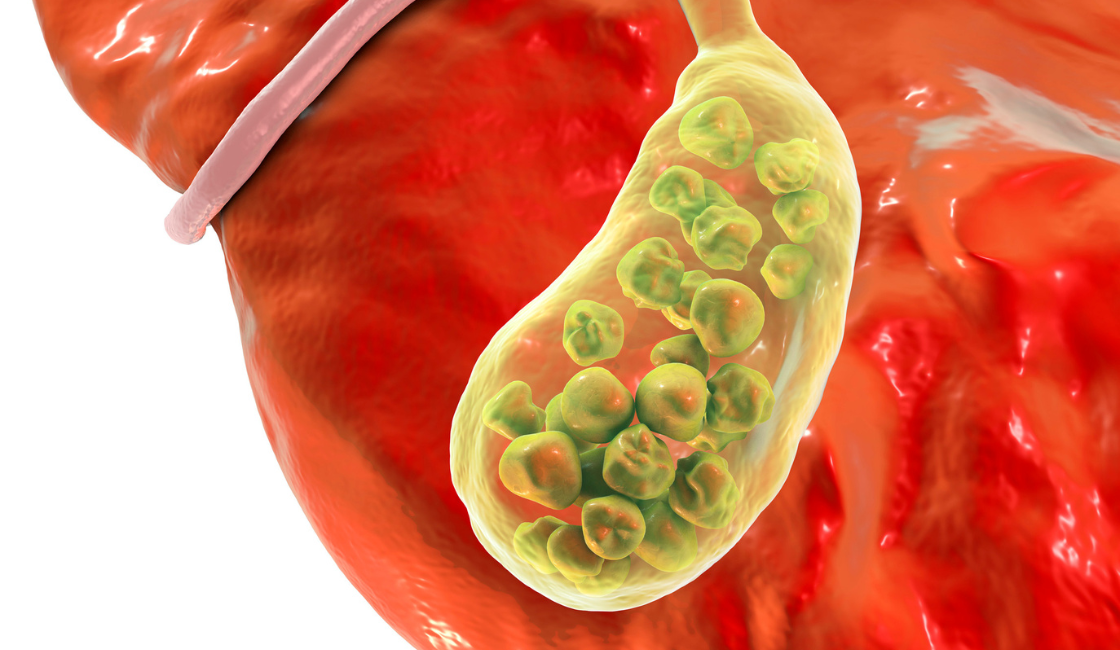 glutathione gallstones to dissolve Recent investigation of the medicinal plants' effectiveness in the natural management of urinary and gallstones: a review Glutathione-Responsive Gold Nanoparticles as Computed Is Glutathione Good for Gallbladder