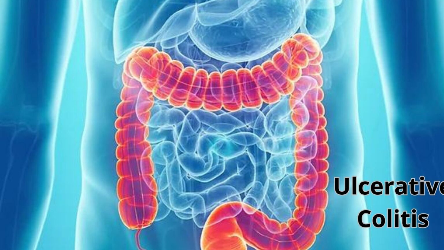 Ulcerative Colitis - Centre of Excellence for Minimal Access Surgery