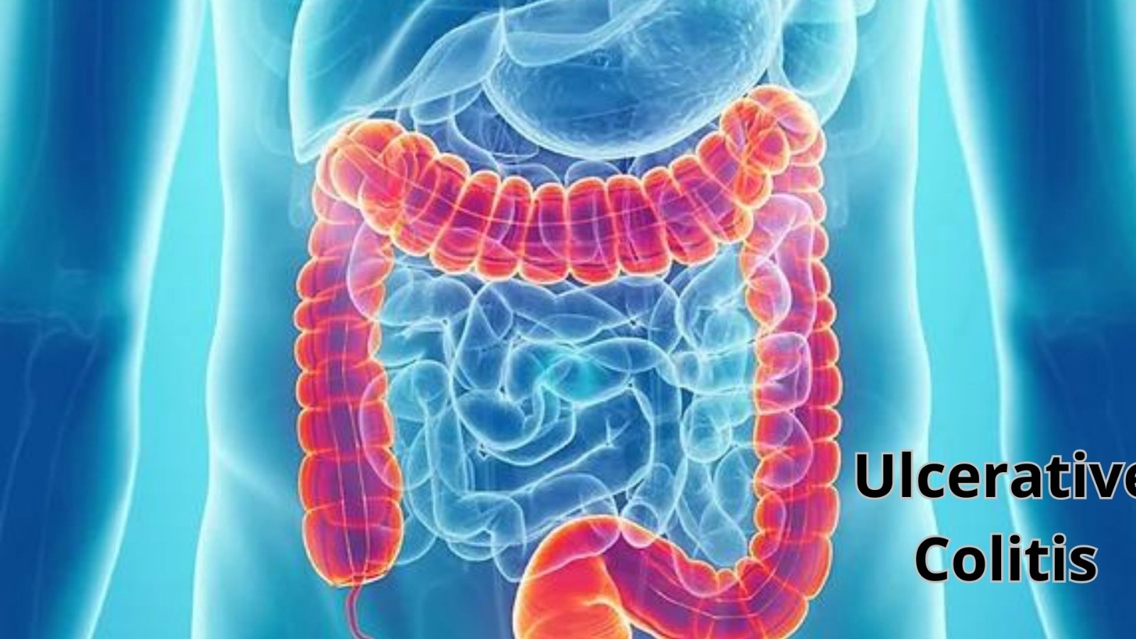 Ulcerative Colitis - Centre Of Excellence For Minimal Access Surgery