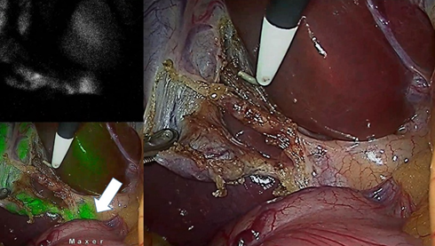 Gallbladder Surgery