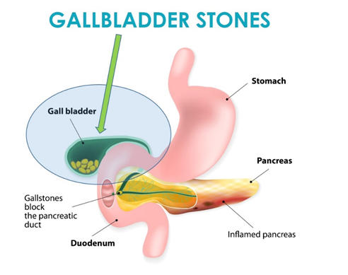 Gallstone treatment in Bangalore