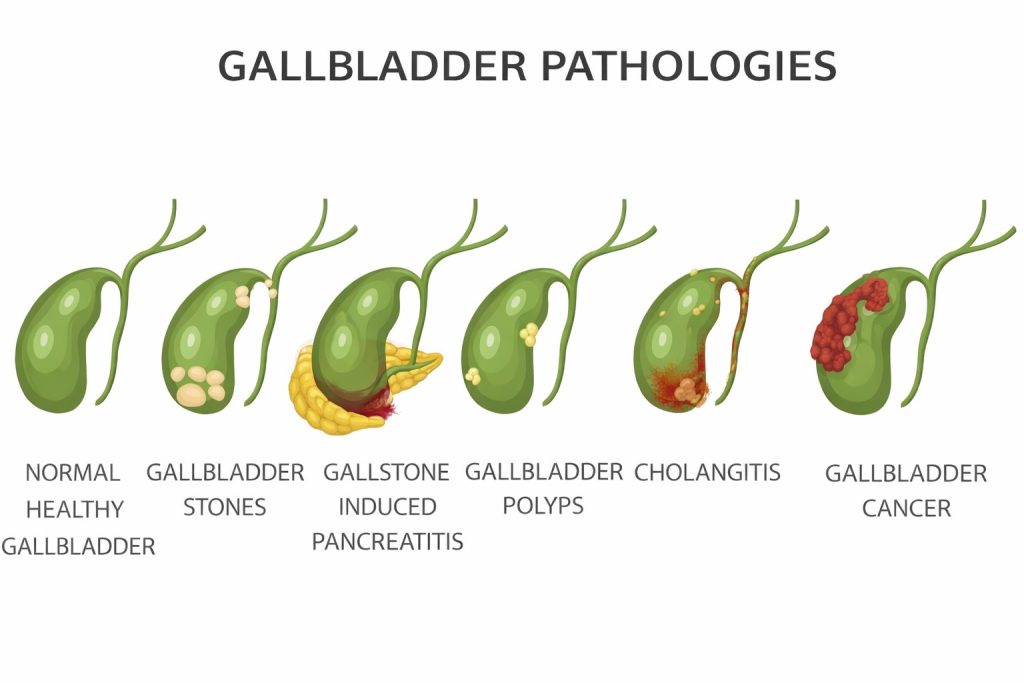 Hidden Signs of Gallbladder Disease