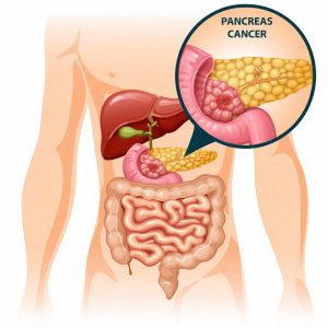 Pancreatic tumour